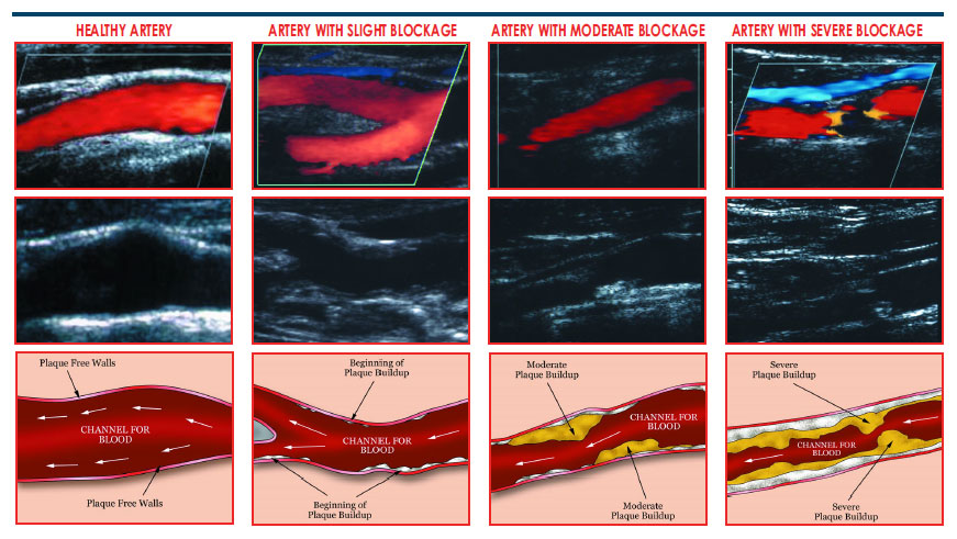 Vascular Screening - non-invasive ultrasound technology